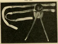 An illustration from The principles and practice of modern surgery / by Roswell Park ... with 722 engravings and 60 full-page plates in colors and monochrome. (1907)