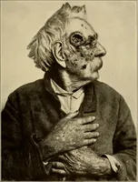 Picture 19 of 129 from Surgical diagnosis / by Edward Martin ... illustrated with 445 engravings and 18 plates in colors and monochrome. (1909), leaf 105