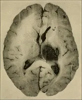 Picture 27 of 129 from Surgical diagnosis / by Edward Martin ... illustrated with 445 engravings and 18 plates in colors and monochrome. (1909), leaf 175