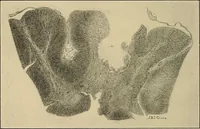 Picture 28 of 129 from Surgical diagnosis / by Edward Martin ... illustrated with 445 engravings and 18 plates in colors and monochrome. (1909), leaf 180