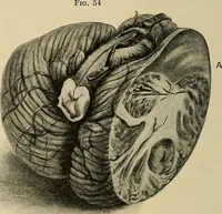 An illustration from Surgical diagnosis / by Edward Martin ... illustrated with 445 engravings and 18 plates in colors and monochrome. (1909)