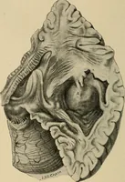 Picture 29 of 129 from Surgical diagnosis / by Edward Martin ... illustrated with 445 engravings and 18 plates in colors and monochrome. (1909), leaf 186