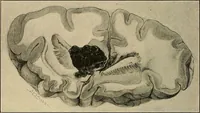 An illustration from Surgical diagnosis / by Edward Martin ... illustrated with 445 engravings and 18 plates in colors and monochrome. (1909)