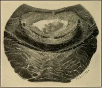 An illustration from Surgical diagnosis / by Edward Martin ... illustrated with 445 engravings and 18 plates in colors and monochrome. (1909)