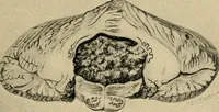 An illustration from Surgical diagnosis / by Edward Martin ... illustrated with 445 engravings and 18 plates in colors and monochrome. (1909)
