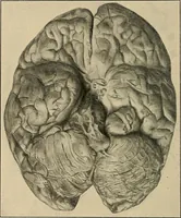 An illustration from Surgical diagnosis / by Edward Martin ... illustrated with 445 engravings and 18 plates in colors and monochrome. (1909)