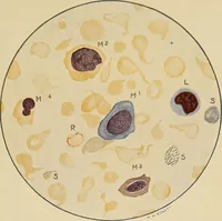 An illustration from Surgical diagnosis / by Edward Martin ... illustrated with 445 engravings and 18 plates in colors and monochrome. (1909)