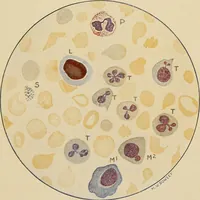 An illustration from Surgical diagnosis / by Edward Martin ... illustrated with 445 engravings and 18 plates in colors and monochrome. (1909)