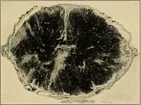 An illustration from Surgical diagnosis / by Edward Martin ... illustrated with 445 engravings and 18 plates in colors and monochrome. (1909)