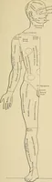 An illustration from Surgical diagnosis / by Edward Martin ... illustrated with 445 engravings and 18 plates in colors and monochrome. (1909)