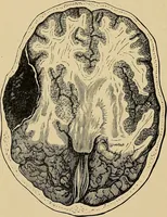 An illustration from Surgical diagnosis / by Edward Martin ... illustrated with 445 engravings and 18 plates in colors and monochrome. (1909)
