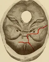 An illustration from Surgical diagnosis / by Edward Martin ... illustrated with 445 engravings and 18 plates in colors and monochrome. (1909)