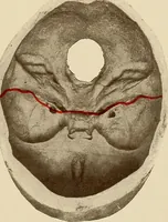 Picture 55 of 129 from Surgical diagnosis / by Edward Martin ... illustrated with 445 engravings and 18 plates in colors and monochrome. (1909), leaf 251