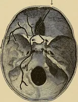 An illustration from Surgical diagnosis / by Edward Martin ... illustrated with 445 engravings and 18 plates in colors and monochrome. (1909)
