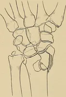 Picture 63 of 129 from Surgical diagnosis / by Edward Martin ... illustrated with 445 engravings and 18 plates in colors and monochrome. (1909), leaf 386