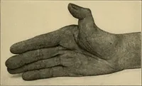 An illustration from Surgical diagnosis / by Edward Martin ... illustrated with 445 engravings and 18 plates in colors and monochrome. (1909)