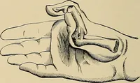 An illustration from Surgical diagnosis / by Edward Martin ... illustrated with 445 engravings and 18 plates in colors and monochrome. (1909)