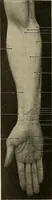 An illustration from Surgical diagnosis / by Edward Martin ... illustrated with 445 engravings and 18 plates in colors and monochrome. (1909)