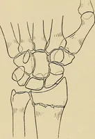 Picture 72 of 129 from Surgical diagnosis / by Edward Martin ... illustrated with 445 engravings and 18 plates in colors and monochrome. (1909), leaf 407