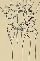 Picture 75 of 129 from Surgical diagnosis / by Edward Martin ... illustrated with 445 engravings and 18 plates in colors and monochrome. (1909), leaf 408