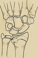 Picture 78 of 129 from Surgical diagnosis / by Edward Martin ... illustrated with 445 engravings and 18 plates in colors and monochrome. (1909), leaf 409