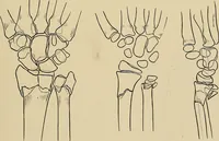 An illustration from Surgical diagnosis / by Edward Martin ... illustrated with 445 engravings and 18 plates in colors and monochrome. (1909)