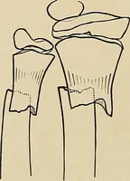 Picture 83 of 129 from Surgical diagnosis / by Edward Martin ... illustrated with 445 engravings and 18 plates in colors and monochrome. (1909), leaf 412