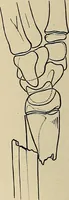 An illustration from Surgical diagnosis / by Edward Martin ... illustrated with 445 engravings and 18 plates in colors and monochrome. (1909)