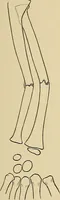 Picture 86 of 129 from Surgical diagnosis / by Edward Martin ... illustrated with 445 engravings and 18 plates in colors and monochrome. (1909), leaf 419