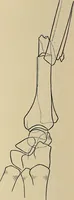 An illustration from Surgical diagnosis / by Edward Martin ... illustrated with 445 engravings and 18 plates in colors and monochrome. (1909)
