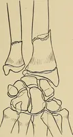 An illustration from Surgical diagnosis / by Edward Martin ... illustrated with 445 engravings and 18 plates in colors and monochrome. (1909)