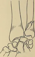 Picture 91 of 129 from Surgical diagnosis / by Edward Martin ... illustrated with 445 engravings and 18 plates in colors and monochrome. (1909), leaf 424