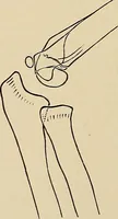 An illustration from Surgical diagnosis / by Edward Martin ... illustrated with 445 engravings and 18 plates in colors and monochrome. (1909)
