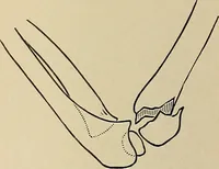 Picture 94 of 129 from Surgical diagnosis / by Edward Martin ... illustrated with 445 engravings and 18 plates in colors and monochrome. (1909), leaf 428
