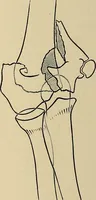 An illustration from Surgical diagnosis / by Edward Martin ... illustrated with 445 engravings and 18 plates in colors and monochrome. (1909)