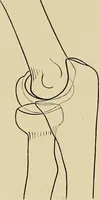 Picture 98 of 129 from Surgical diagnosis / by Edward Martin ... illustrated with 445 engravings and 18 plates in colors and monochrome. (1909), leaf 433