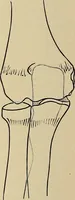 An illustration from Surgical diagnosis / by Edward Martin ... illustrated with 445 engravings and 18 plates in colors and monochrome. (1909)