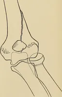 Picture 100 of 129 from Surgical diagnosis / by Edward Martin ... illustrated with 445 engravings and 18 plates in colors and monochrome. (1909), leaf 437