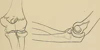 Picture 101 of 129 from Surgical diagnosis / by Edward Martin ... illustrated with 445 engravings and 18 plates in colors and monochrome. (1909), leaf 439