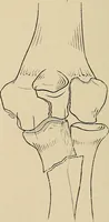 Picture 103 of 129 from Surgical diagnosis / by Edward Martin ... illustrated with 445 engravings and 18 plates in colors and monochrome. (1909), leaf 442