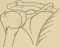Picture 108 of 129 from Surgical diagnosis / by Edward Martin ... illustrated with 445 engravings and 18 plates in colors and monochrome. (1909), leaf 461