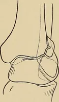 Picture 110 of 129 from Surgical diagnosis / by Edward Martin ... illustrated with 445 engravings and 18 plates in colors and monochrome. (1909), leaf 602