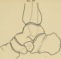 An illustration from Surgical diagnosis / by Edward Martin ... illustrated with 445 engravings and 18 plates in colors and monochrome. (1909)