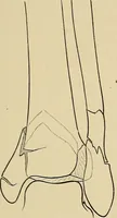 Picture 112 of 129 from Surgical diagnosis / by Edward Martin ... illustrated with 445 engravings and 18 plates in colors and monochrome. (1909), leaf 611