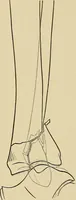 An illustration from Surgical diagnosis / by Edward Martin ... illustrated with 445 engravings and 18 plates in colors and monochrome. (1909)