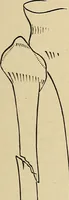 An illustration from Surgical diagnosis / by Edward Martin ... illustrated with 445 engravings and 18 plates in colors and monochrome. (1909)