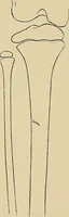 Picture 115 of 129 from Surgical diagnosis / by Edward Martin ... illustrated with 445 engravings and 18 plates in colors and monochrome. (1909), leaf 622