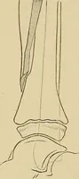 An illustration from Surgical diagnosis / by Edward Martin ... illustrated with 445 engravings and 18 plates in colors and monochrome. (1909)