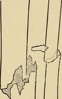 An illustration from Surgical diagnosis / by Edward Martin ... illustrated with 445 engravings and 18 plates in colors and monochrome. (1909)