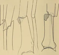 An illustration from Surgical diagnosis / by Edward Martin ... illustrated with 445 engravings and 18 plates in colors and monochrome. (1909)